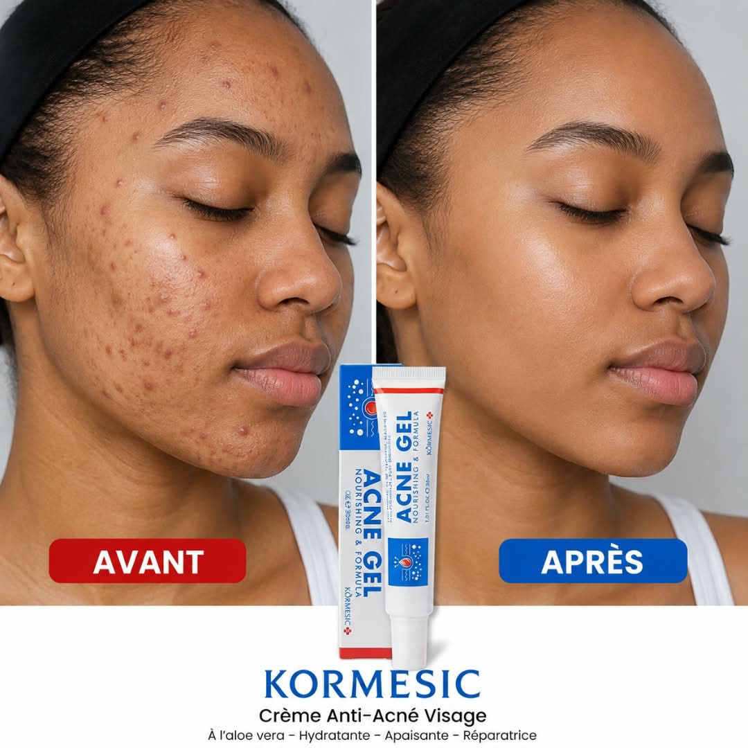 Crème Anti-Acné KORMESIC – 30 ml